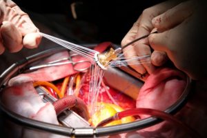 operaciya po zamene aortalnogo klapana