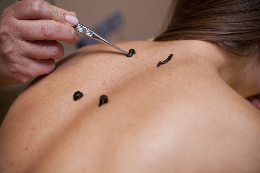 Что делает пиявка с кровью — объясняем про гирудотерапию на пальцах