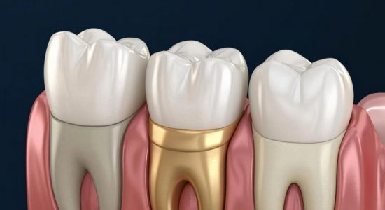 Вкладки на зуб: Inlay, Onlay, Overlay - что выбрать? 7 Вкладки на зуб: Inlay, Onlay, Overlay - что выбрать?